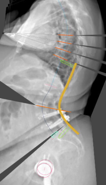 A scan of a patient using brand new spine surgery technology: the Mazor UNiD system.